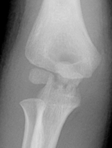 igure 1_isolated-olecranon-fracture-AP.jpg